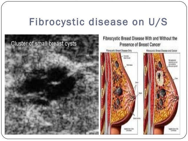 fibrocystic breast clusters Shemales suck fuck each other